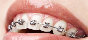 <span style="font-weight: bold; text-decoration: underline;"><a href="/ortopediya" target="_self">ОРТОДОНТИЧЕСКАЯ СТОМАТОЛОГИЯ</a></span>
Ортодонтическое лечение предназначено для исправления аномалий прикуса, положения зубов, формы зубных дуг. В ортодонтии используется только строго индивидуальный подход!!!